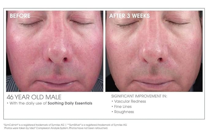 Glowbiotics Calming Restorative Treatment - Probiotic Redness Relief Serum for Sensitive Skin & Rosacea (1 fl oz)