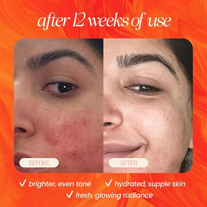 Mudita Earth Pineapple Bright Vitamin C Serum – 1 Fl Oz | Vitamin C & Niacinamide Serum for Acne Scars, Dark Spots & Hyperpigmentation, Glow-Enhancing & Even Tone Support with Rosehip, Hyaluronic Acid